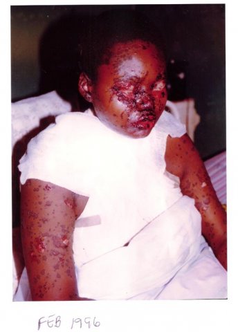 nadier withsjs all bandaged up- feb 1996